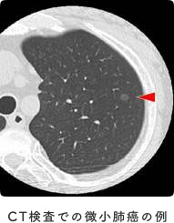 CT検査での微小肺癌の例